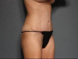 tummy-tuck-austin-tx