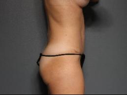 tummy-tuck-austin-tx