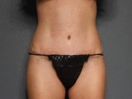 tummy-tuck-austin-tx