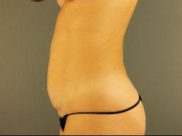 tummy-tuck-austin-tx