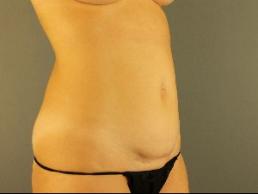 tummy-tuck-austin-tx