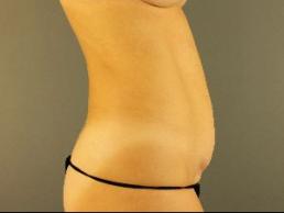 tummy-tuck-austin-tx