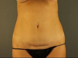 tummy-tuck-austin-tx