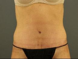 tummy-tuck-austin-tx