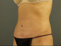 tummy-tuck-austin-tx
