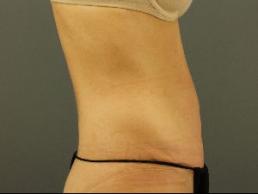 tummy-tuck-austin-tx