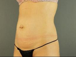 tummy-tuck-austin-tx