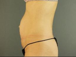 tummy-tuck-austin-tx