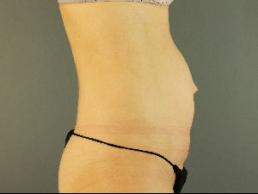 tummy-tuck-austin-tx