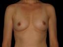 breast-augmentation-austin-tx