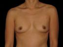breast-augmentation-austin-tx