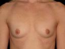 breast-augmentation-austin-tx