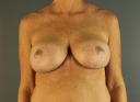 breast-revision-austin-tx