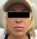 fillers-and-toxins-austin-tx
