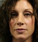 fillers-and-toxins-austin-tx