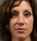 fillers-and-toxins-austin-tx