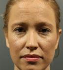 fillers-and-toxins-austin-tx