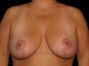 breast-reduction-austin-tx