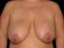 breast-reduction-austin-tx