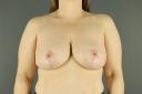 breast-reduction-austin-tx