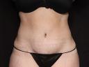 tummy-tuck-360-austin-tx